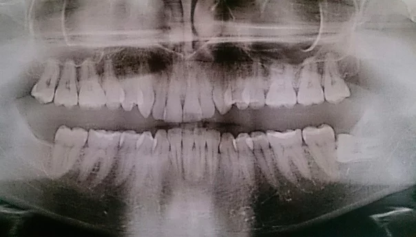 The story of how I wore braces - My, Teeth, Braces, Longpost, Orthodontics