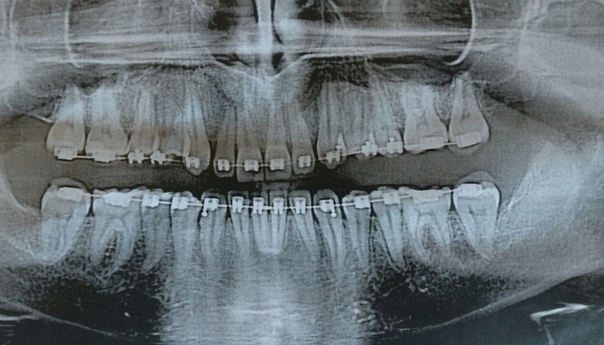 The story of how I wore braces - My, Teeth, Braces, Longpost, Orthodontics