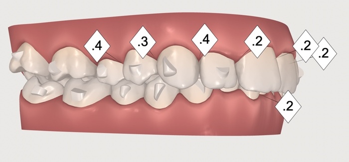 [ 2]     "   "   .   6 ! , , ,  , , , , , , Invisalign