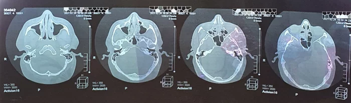 Continuation of the post “Hi, my name is Astart13 and I’m a drug addict!” - My, Vasomotor rhinitis, Operation, Addiction, Nasal spray, Habituation, Reply to post, Longpost, Septoplasty