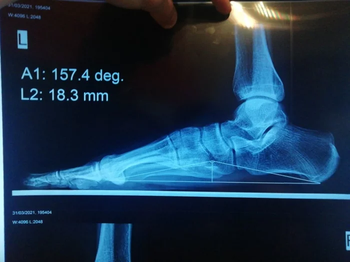 Правильно ли расчерчен снимок - Моё, Медицина, Рентген, Рентгеновские снимки, Плоскостопие, Армия