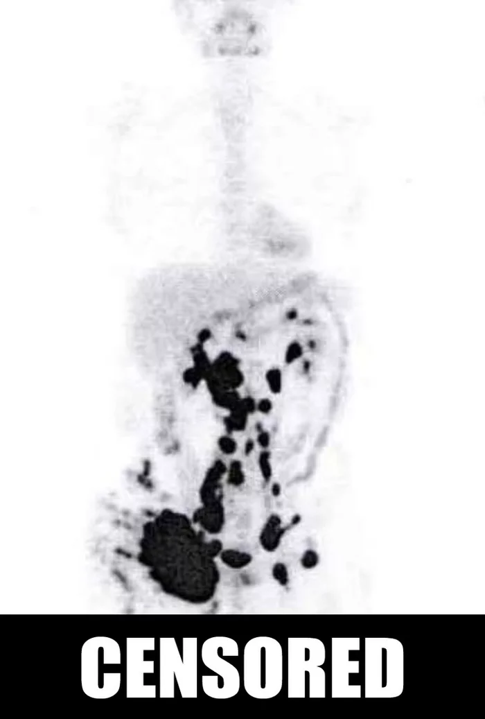 Diffuse large B-cell lymphoma. C83.3. Part 2. End of diagnosis - My, Lymphoma, Non-Hodgkin lymphoma, Lymph nodes, Disease history, Cancer and oncology, Hematology, Longpost