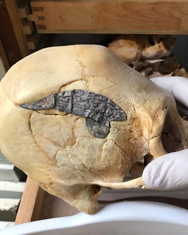 Peruvian skull with metal, surgically implanted after returning from battle, believed to be around 2,000 years ago - Scull, Metal, Operation, Interesting, Implantation