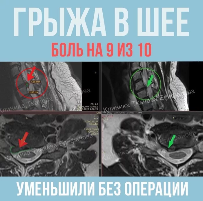 How Herman cured a huge herniated disc in his neck - My, The medicine, Neurologist, Intervertebral hernia, Health, Neurosurgery, Video, Longpost