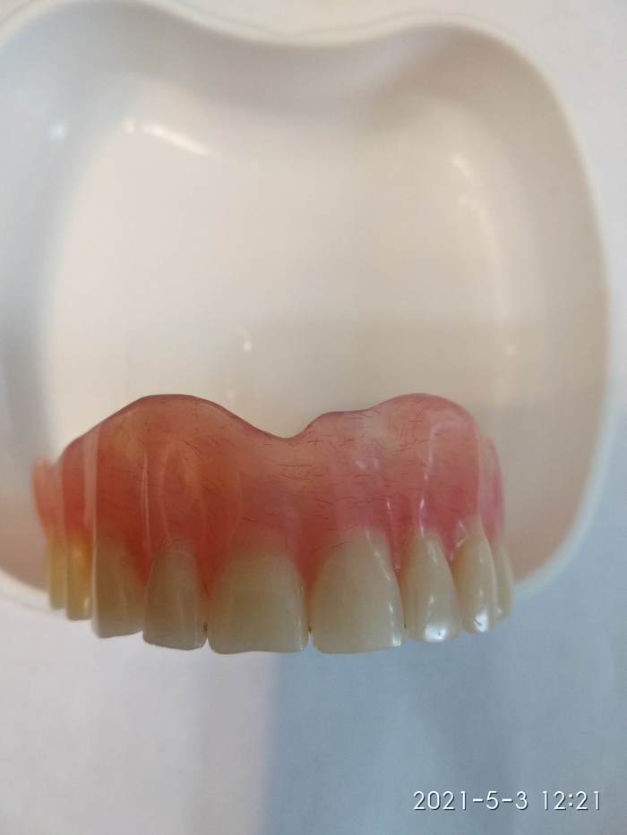 Teeth, or rather artificial teeth. Part 3 - My, Dentistry, Teeth, Longpost