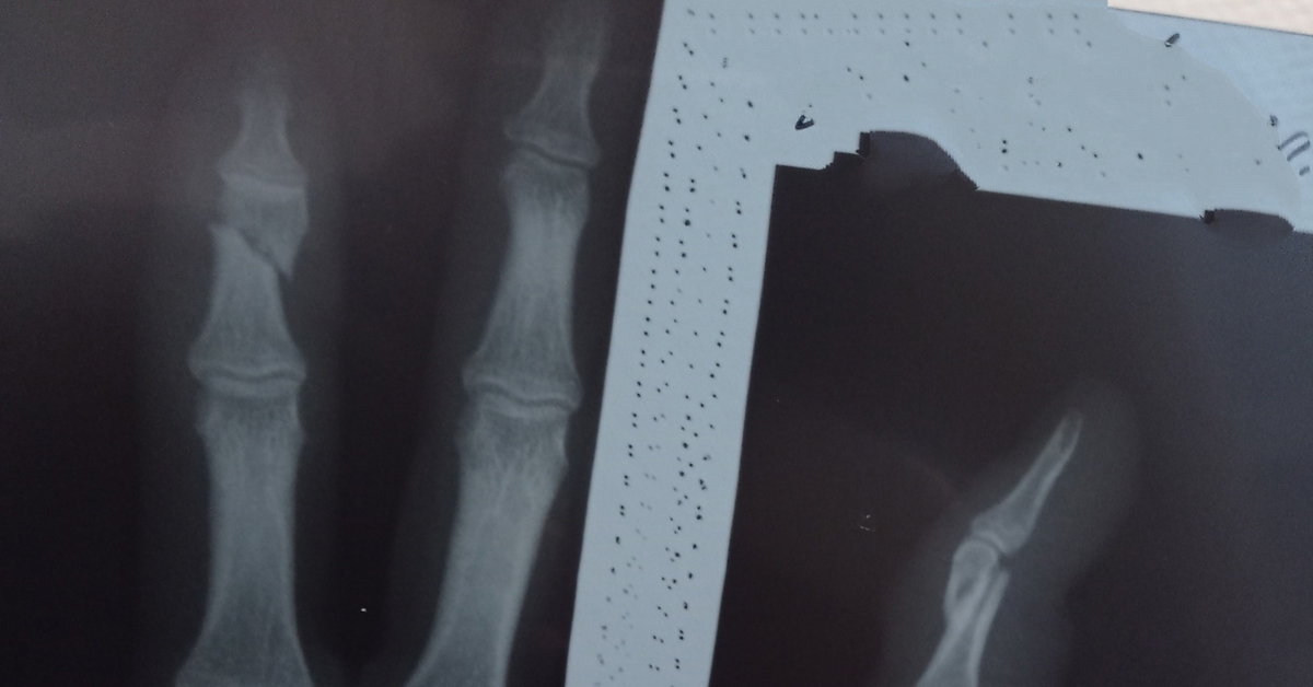 Broke my finger - My, Finger fracture, Hospital, Help