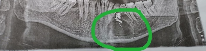 Question for Dental League - My, Teeth, No rating, Cyst, Dentistry