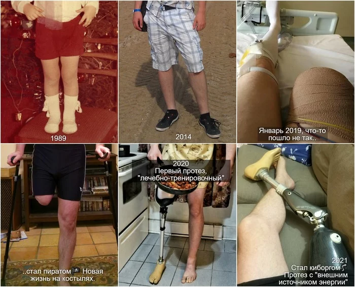 The evolution of my foot - My, Picture with text, Black humor, Prosthesis, Amputation, Disabled person, Legs, Injury, The photo, , Self-irony