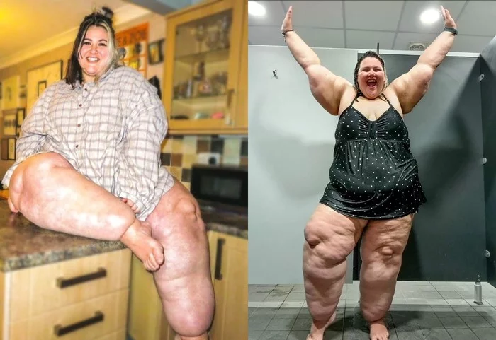 The girl's legs swelled to an unprecedented size, despite diets and sports, but the doctors clarified - Girls, Disease, Disabled person, Strength of will, Instagram, Text, The photo, Life, Longpost