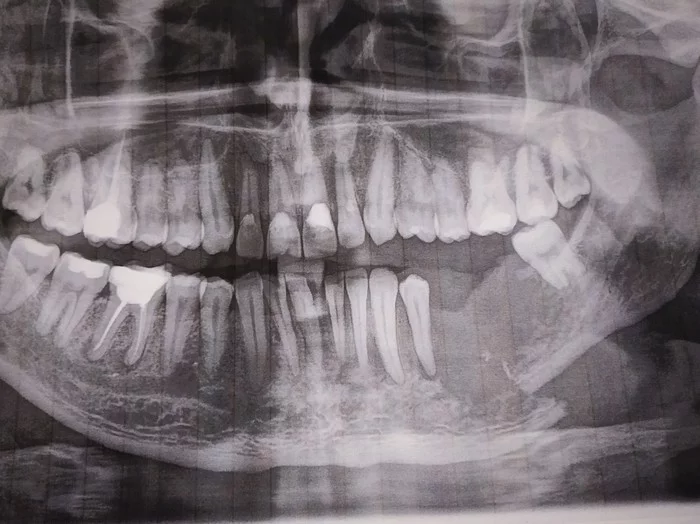 Squamous cell carcinoma of the mandible. Part 3 - My, Oncology, Crayfish, Jaw, Teeth, Gums, Disease history, Text, Longpost