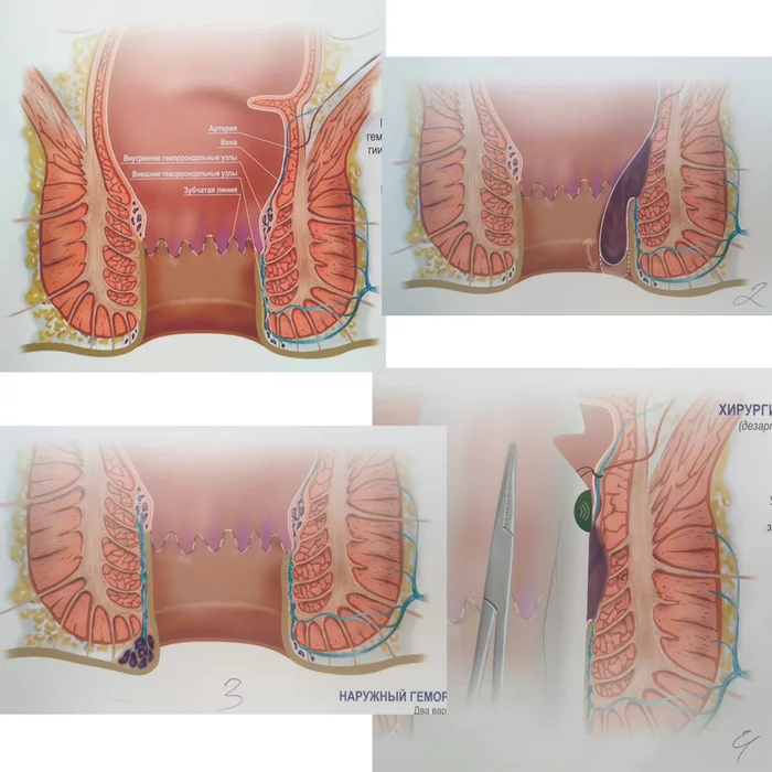 How we made a poster for a doctor - My, Poster, Creation, Haemorrhoids, Longpost