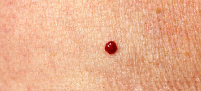 Skin hemangiomas - The medicine, Post #10667838, Doctors, Dermatology, Disease, Leather, Health, Article, Longpost