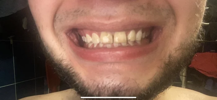 Teeth parted after wearing braces, the cap broke, is it possible to restore the bite this time without braces? - Dentistry, Bad teeth