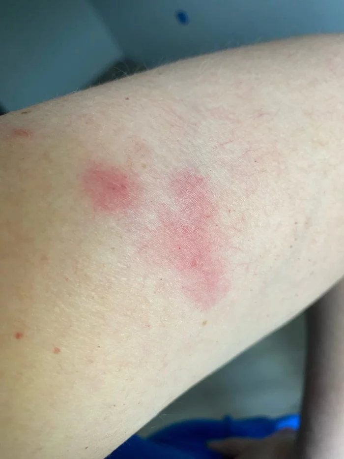 Post-injection local complication - My, The medicine, Vaccination, No rating, Dermatology, Surgery, Need advice, Longpost