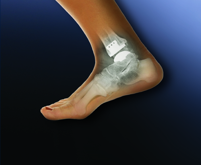 Endoprostheses of the ankle joint. Small overview - My, Text, Longpost, The medicine, Endoprosthetics, Overview