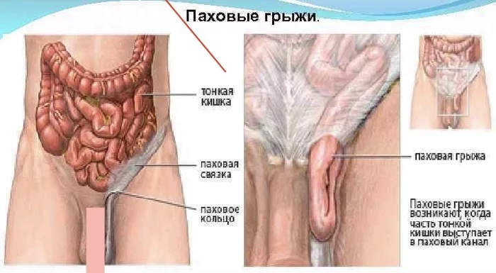 Паховая грыжа (нужен совет) - Моё, Без рейтинга, Грыжа, Медицина, Операция, Хирургия, Хирург, Страшно, Совет, , Нужен совет, Вопрос, Врачи, Нужна помощь врачей