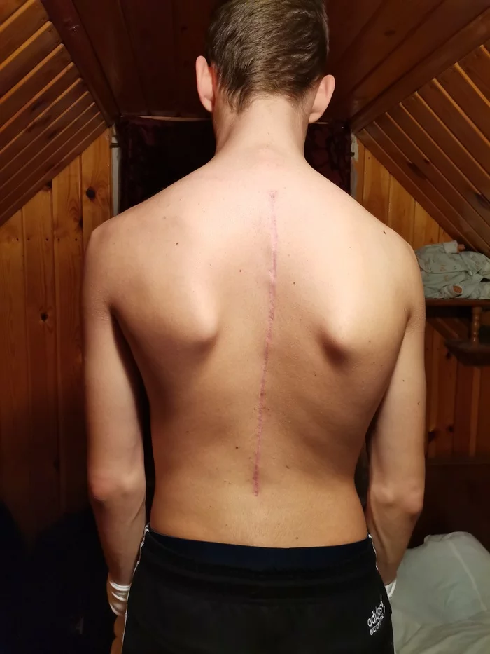 Spinal surgery for scoliosis - My, Back, Health, Motivation, Life stories, Treatment, Scoliosis, Hospital, Resuscitation, Longpost, , Disease