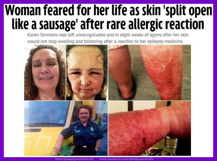 Аллергия на лекарство от эпилепсии