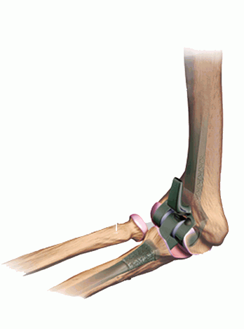 Endoprostheses of the elbow joint. - My, Text, Longpost, The medicine, Endoprosthetics, Overview