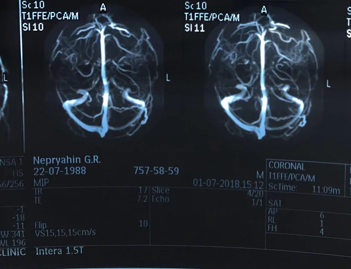 Cervical osteochondrosis WILL WIN and we must treat it correctly !!! Before and after (May 2018 acute period and now 07/21/2021) - My, Osteochondrosis, Neck, Longpost, It Was-It Was, Life stories, Video