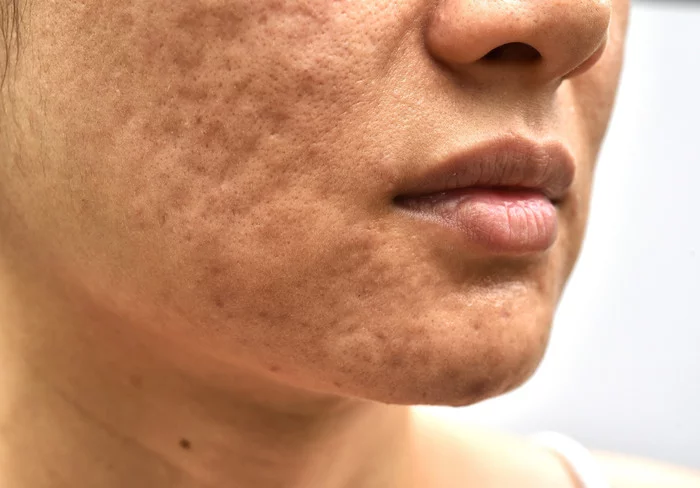 Skin retouching with frequency (and not only :)) - My, Acne, Naturally, Leather, Retouch, It Was-It Was