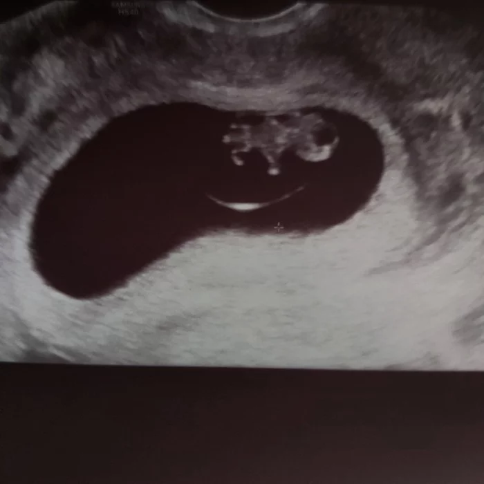 Full head pregnant - My, Pregnancy, Ultrasound