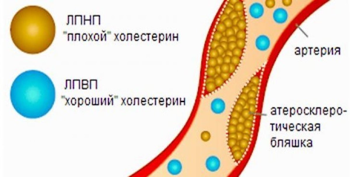 Хороший холестерин. Высокий холестерин на локтях. Прививка от холестерина. Женщины холестерин табличка. Что значит повышение холестерина.