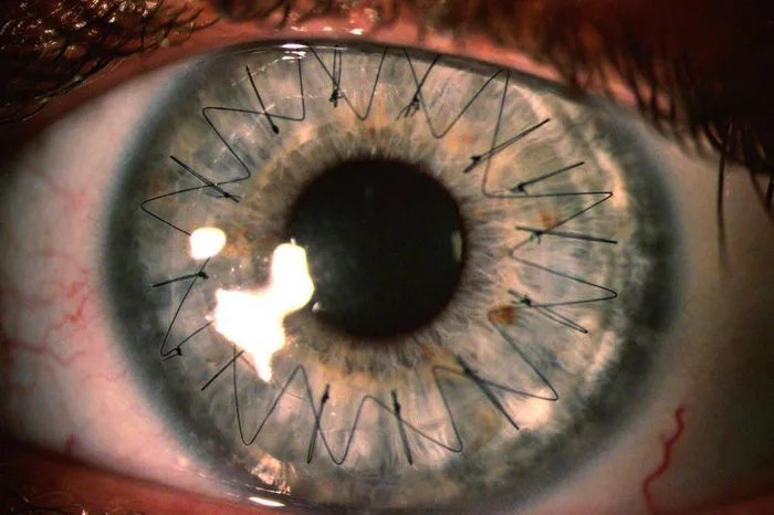 Incredible macro shot of the human eye showing stitches from a recent corneal transplant - Eyes, Operation, Cornea