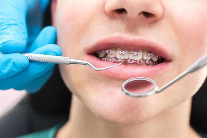 The cost of braces | Why so expensive? - My, Braces, Orthodontics, Bite, Dentistry, The medicine, beauty, Doctors, Dentist, Longpost