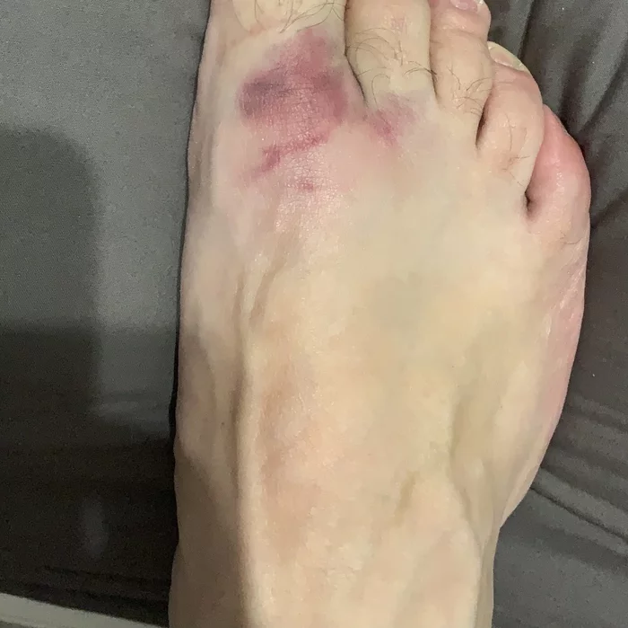 What was it? - My, Injury, Bruise, Pain, Need advice