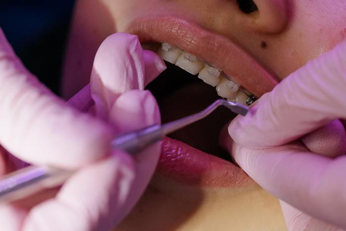 New orthodontist | Aftertreatment on braces - My, Orthodontics, Braces, Bite, Dentistry, Longpost