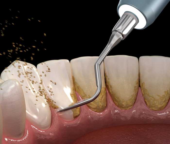 Ultrasonic teeth cleaning | clearly - My, Teeth cleaning, , Dentistry, Teeth, Dentist, The medicine, beauty, Health