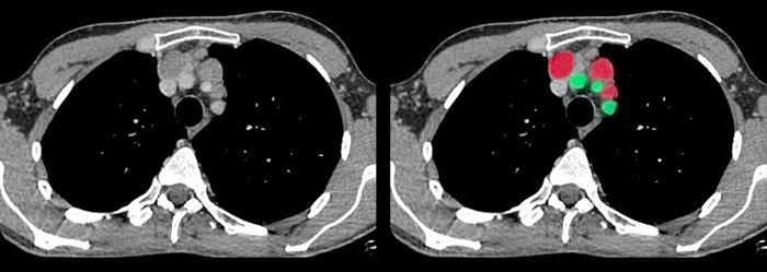 Диагностика онкологии на ранней стадии. Как COVID помогает моим пациентам - Моё, Онкология, Хирургия, Коронавирус, Медицина, Рентгенология, Кт, Длиннопост