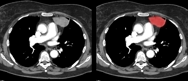 Diagnosis of cancer at an early stage. - My, Oncology, Surgery, Coronavirus, The medicine, Radiology, CT, Longpost