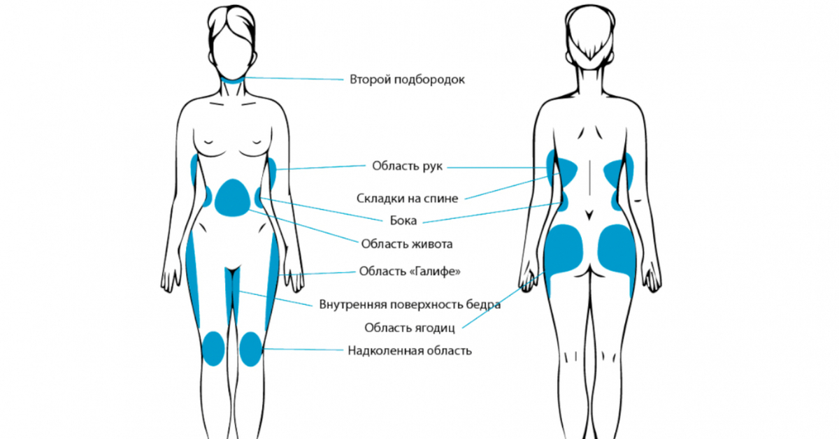 В каком месте сделать. Жировые ловушки на теле у женщины. Зоны липосакции на теле схема. Зоны для липолитиков по телу. Зоны для липосакции у женщин.