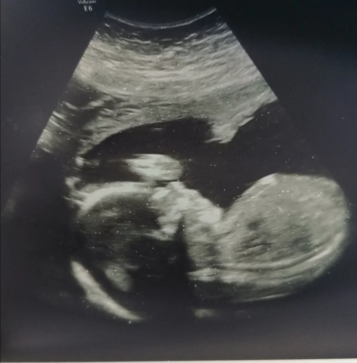 Second post, or happened) - My, Pregnancy, Pregnant, Ultrasound