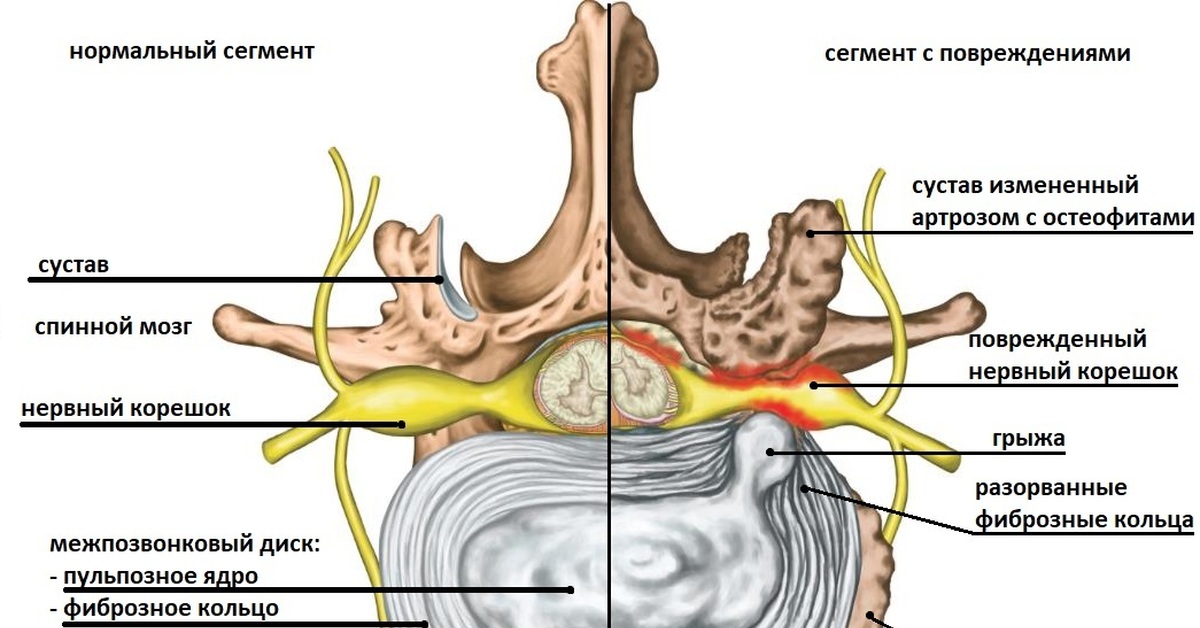 Может ли грыжа позвоночника. Нервные корешки с5 с6. Межпозвонковые диск с6/7. Грыжа дисков с5 с6. Грыжа диска с5 с6 шейного отдела.