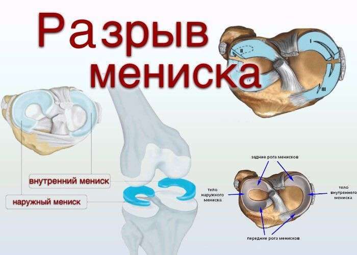 My knee arthroscopy - My, Knee, Arthroscopy, Meniscus, Meniscus tear, Health, Operation, Longpost