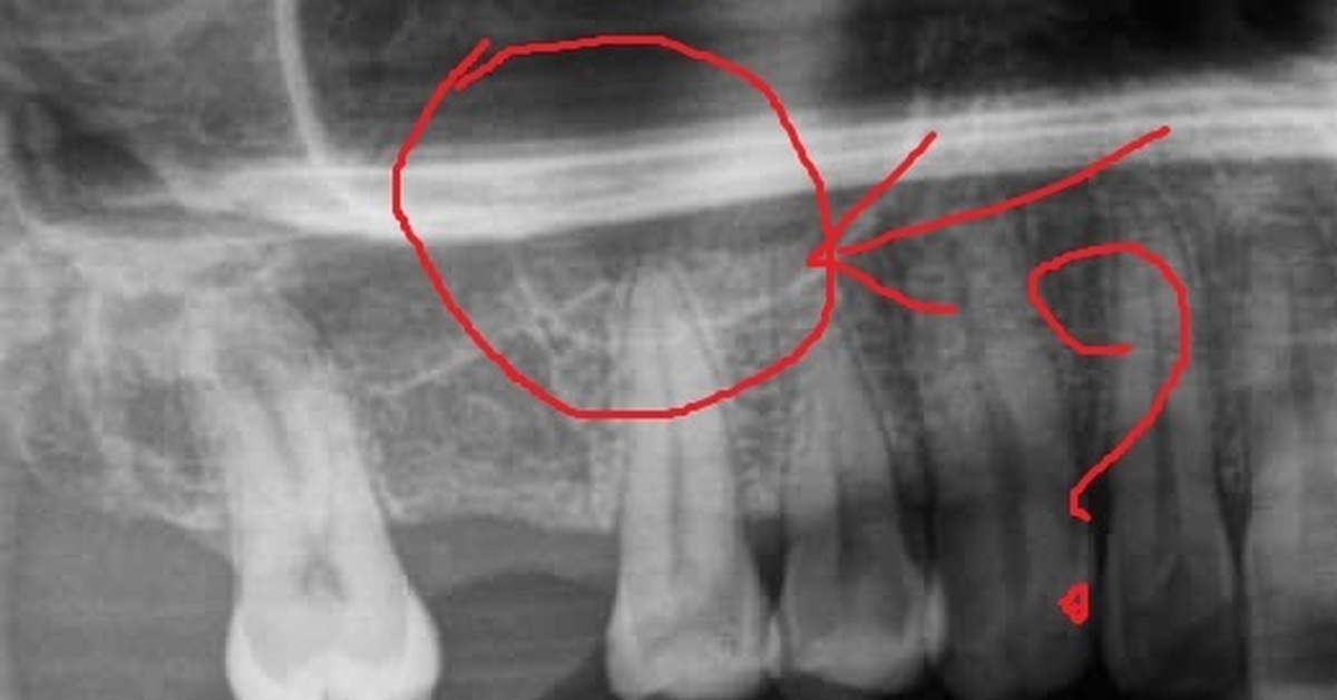 Можно ли увидеть на снимке. Гранулема зуба на снимке. Гранулема зуба фото рентген.