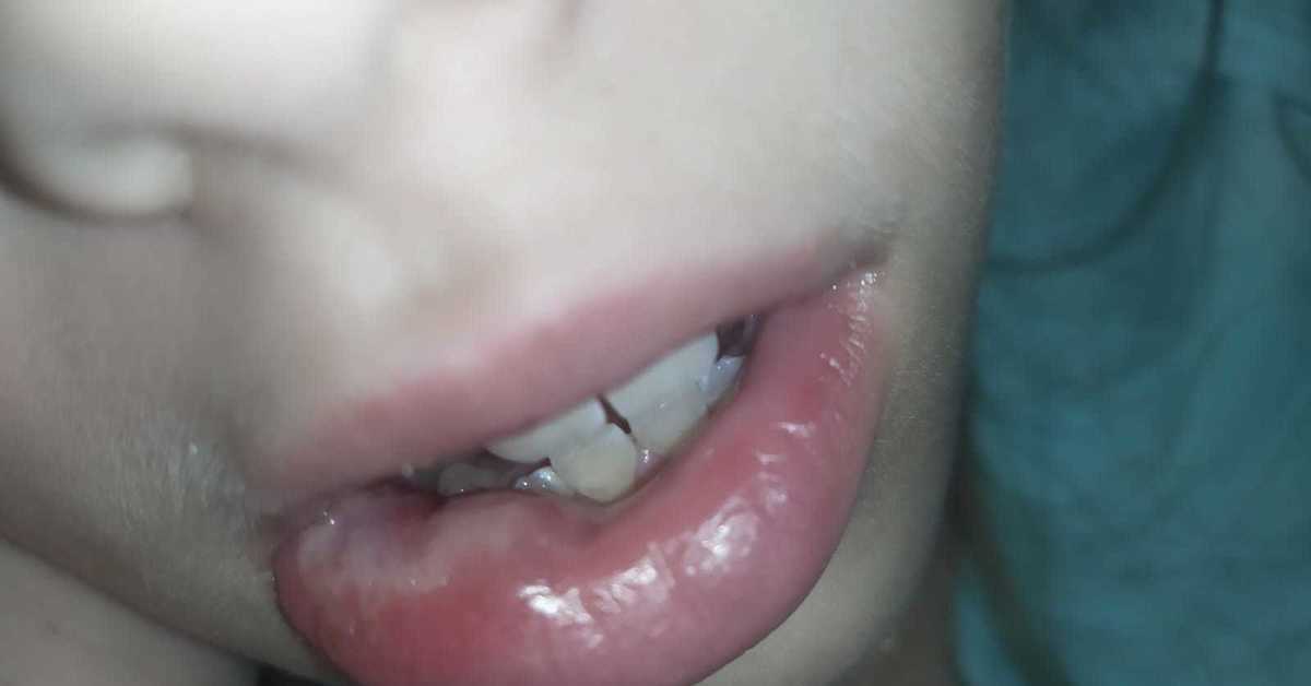 Ребенок прикусил губу - чем помочь и что делать