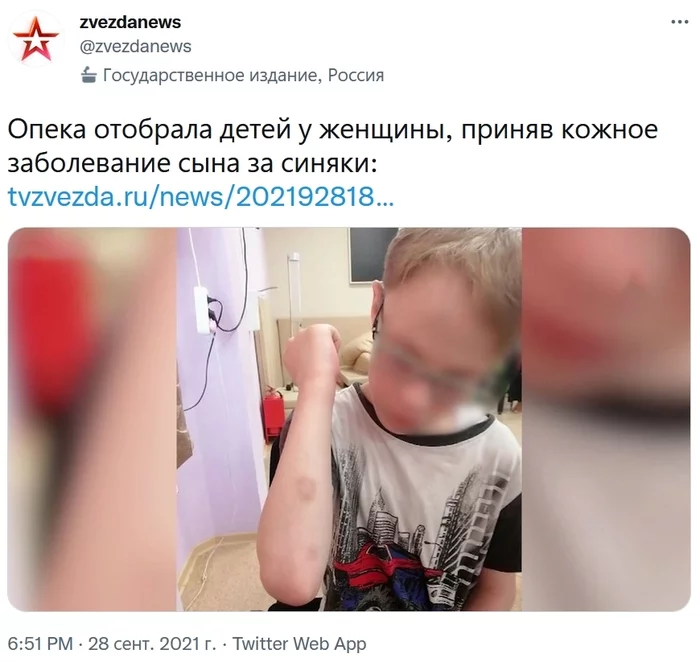 In St. Petersburg, a woman intends to challenge the decision of the guardianship authorities because of the alleged bruises that appeared on her son's arms - Negative, Russia, Officials, Guardianship, Children, Parents and children, Tvzvezdaru, Screenshot, , Twitter, Society, Saint Petersburg, Longpost