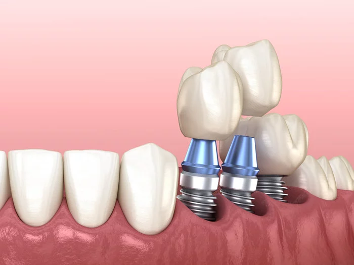 How does dental implant help? - My, Implants, Dental implantation, Dentistry, Teeth, The medicine, Bones, Gum, beauty