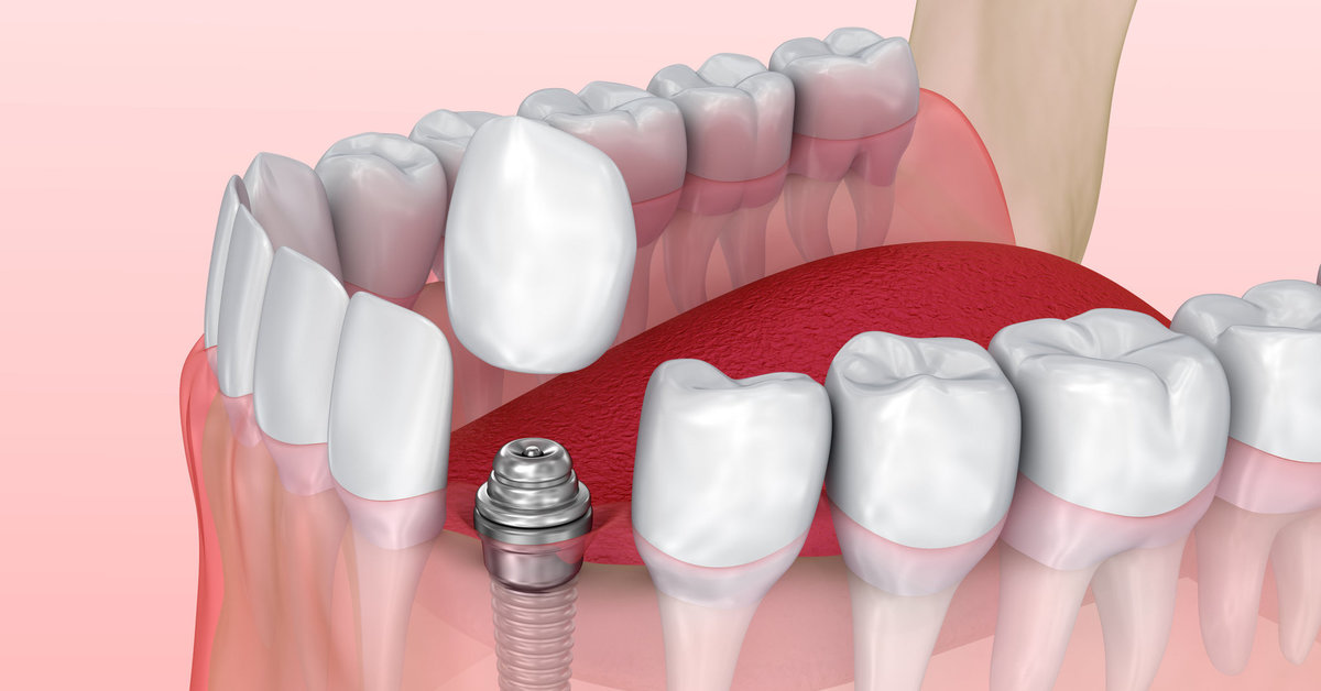 Мягкий имплант. Коронка и имплант разница.