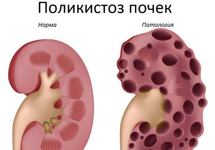 Занимательная нефрология на пальцах для чайников. Часть 3 - Моё, Медицина, Нефрология, Почки, Гифка, Длиннопост