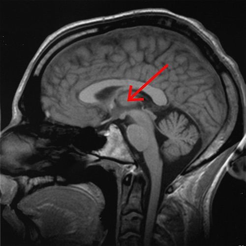 Insomnia, impotence and prions. - The medicine, Insomnia, Genetics, Prions, Longpost