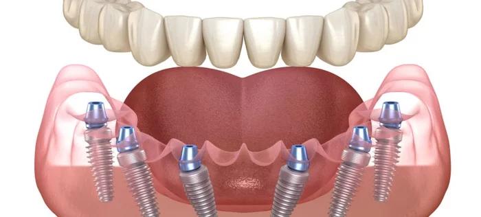 Dental implantation and refusal of doctors to do it - My, Implants, Teeth, Bad teeth