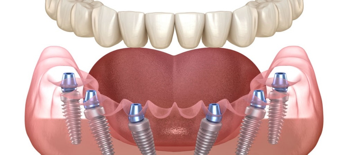 Чит имплант. Nobel Biocare all on 6. Имплантация челюсти на 6 имплантах. Несъёмный зубной протез на 6 имплантах.