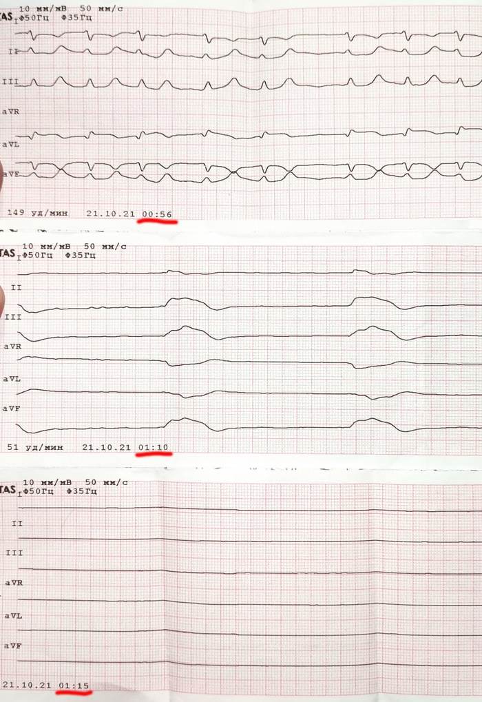 What does death look like on an EKG? - My, ECG, The medicine, Cardiology, Death