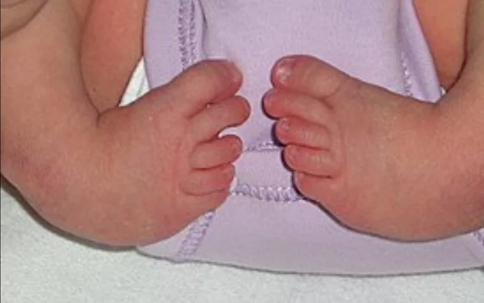 Congenital clubfoot, how to live with it - My, Talipes, Legs, Longpost, Genetic diseases