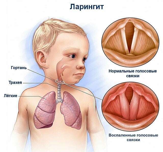 Barking cough or acute laryngitis - My, ARVI, Laryngitis, Croup, Disease, Children, The medicine, Video, Longpost